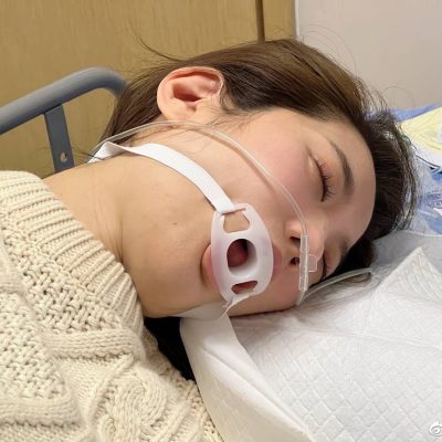 真实美女做胃镜嘴上带口圈的样子图片