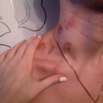 男的脖子上有吻痕丢人吗?男人介意脖子上有吻痕吗?