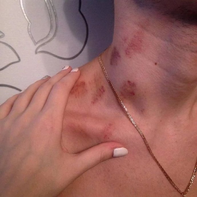 男的脖子上有吻痕丢人吗?男人介意脖子上有吻痕吗?_1