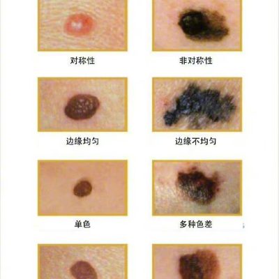 黑色素瘤和普通痣对比图，如何分辨区别？
