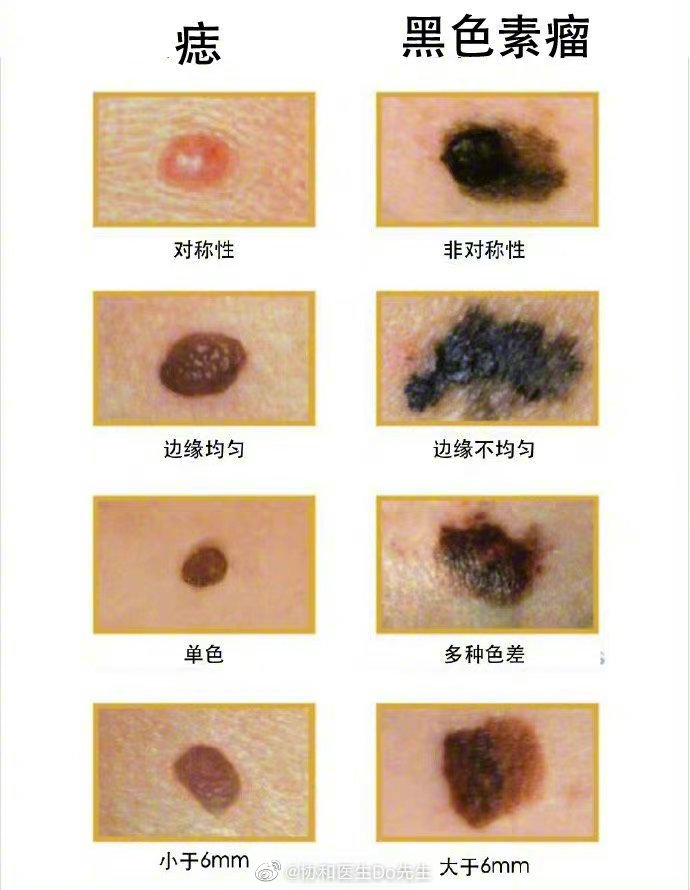 黑色素瘤和普通痣对比图，如何分辨区别？_1